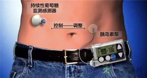 使用胰岛素泵的注意事项