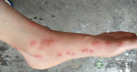 糖尿病脚上起水泡怎么治疗