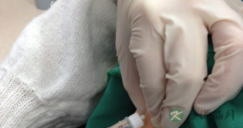 糖尿病伤口如何处理