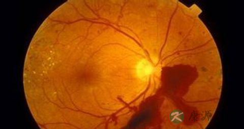 糖尿病如何控制血糖