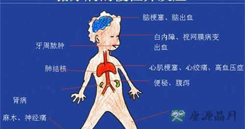 糖尿病防治知识