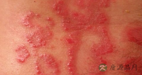 糖尿病皮肤瘙痒起风团怎么办