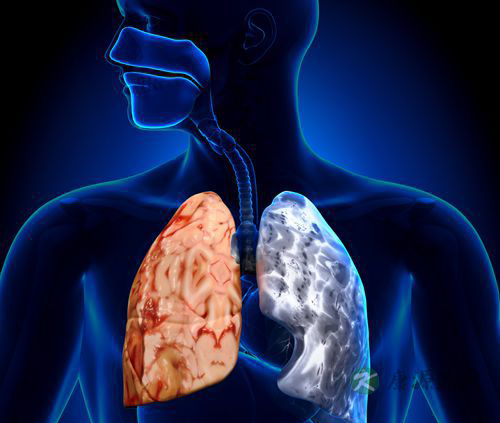 肺结核是什么病 病因和病症是什么