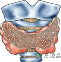 预防甲状腺癌自查五法