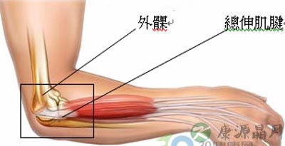 网球肘