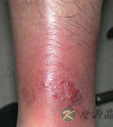 蜂窝组织炎与丹毒