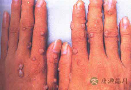 疣是怎么引起的？有哪些症状？