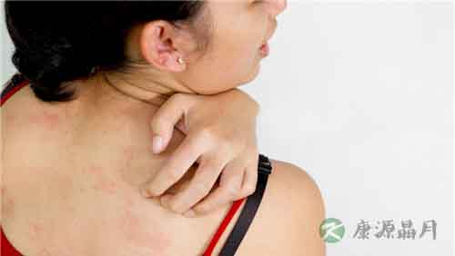 寒冷性荨麻疹是什么？怎么办？