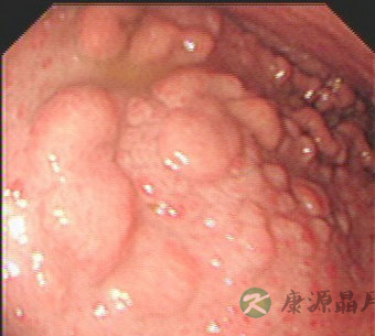 胃息肉