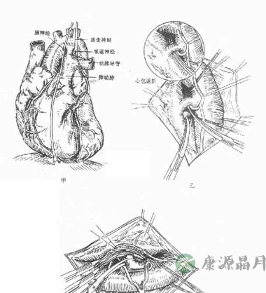 动脉导管未闭的手术治疗