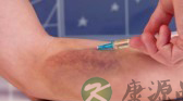 丙型肝炎治疗