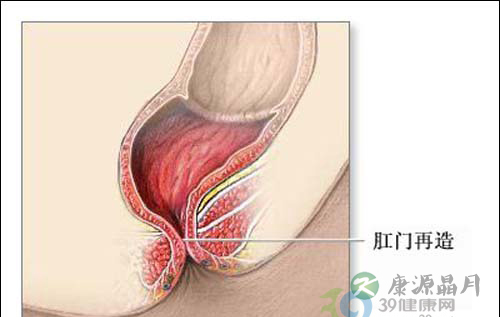 新生儿肛门闭锁如何判断治疗