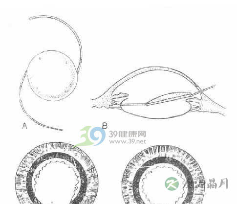 屈光性手术 告别白内障