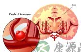 高血压脑出血的治疗