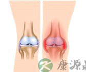 反应性关节炎怎么治疗