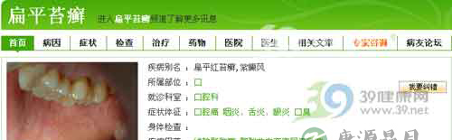 偏方验方治扁平苔癣