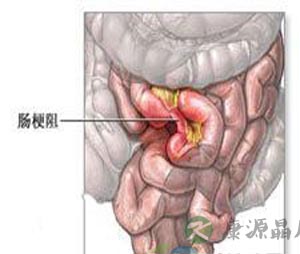 怎样治疗大肠梗阻