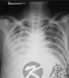 肺水肿是怎么回事