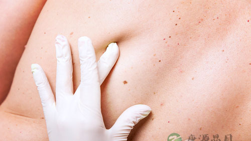 得了外阴黑色素瘤的症状分析 得了外阴黑色素瘤的症状分析