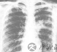 间接性肺炎是什么