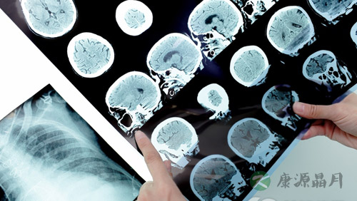 脑震荡有什么后遗症? 脑震荡有什么后遗症?