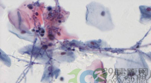 妇科专家：如何自测阴道分泌物是否正常（图）