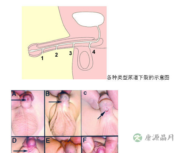 男孩儿“小鸡鸡”太小或是小儿隐匿阴茎 男孩儿“小鸡鸡”太小或是小儿隐匿阴茎