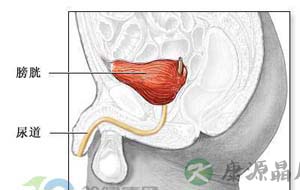 癌症图片：膀胱癌