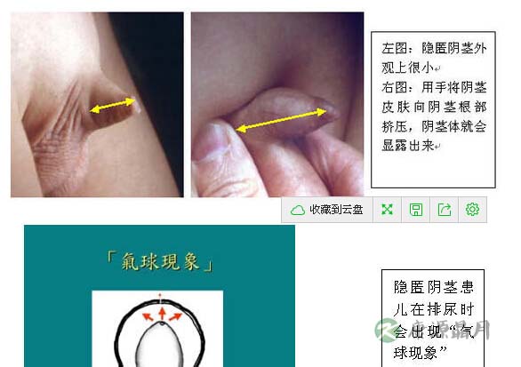 男孩儿“小鸡鸡”太小或是小儿隐匿阴茎 男孩儿“小鸡鸡”太小或是小儿隐匿阴茎