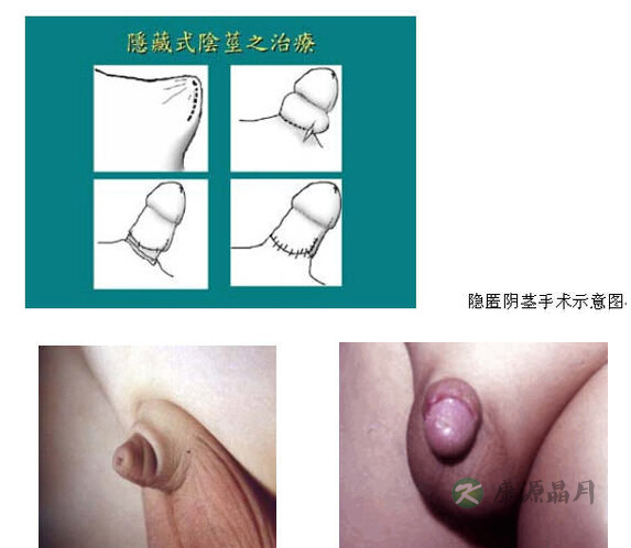 男孩儿“小鸡鸡”太小或是小儿隐匿阴茎 男孩儿“小鸡鸡”太小或是小儿隐匿阴茎