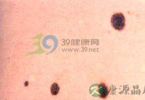 警惕十种易癌变的色素痣