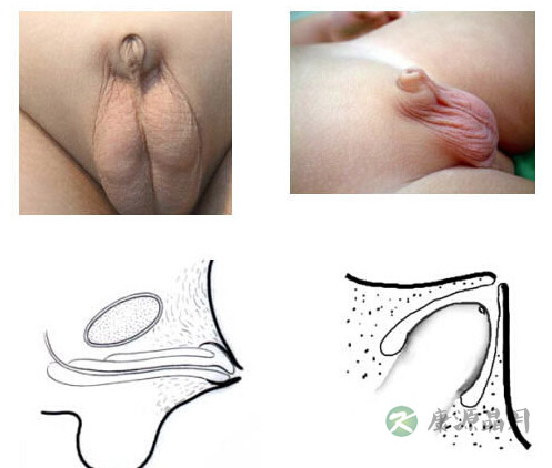 男孩儿“小鸡鸡”太小或是小儿隐匿阴茎 男孩儿“小鸡鸡”太小或是小儿隐匿阴茎