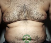 多毛症症状 多毛症症状