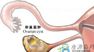 女性腰痛 竟是妇科病作怪