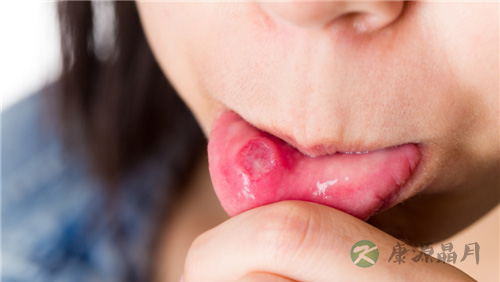 又到手足口病高发季 儿童手足口病症状有哪些