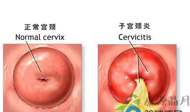 女性腰痛 竟是妇科病作怪