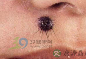 警惕十种易癌变的色素痣