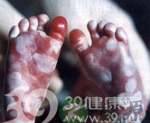 惊叹：孩子也会有性病