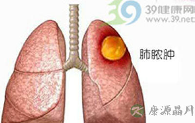 这些肺脓肿“权威知识”你可知？