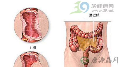 防癌变 结肠息肉早切除