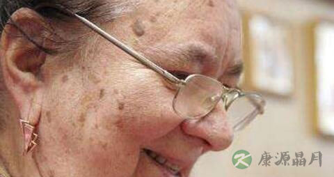 老年斑吃什么药