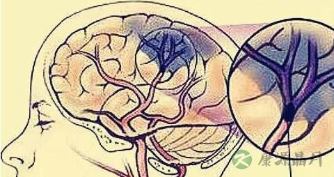 老人脑血栓不说话怎么治