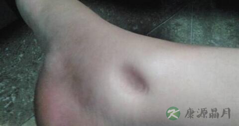 老人脚肿是什么原因引起的