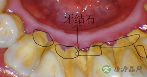 老人洗牙会不会洗掉了