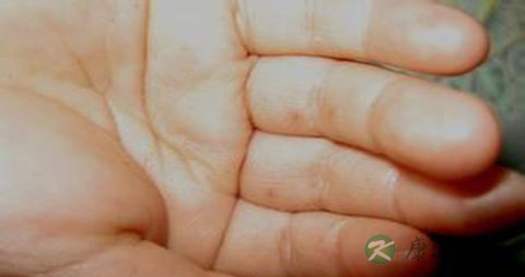 卧床老人手脚浮肿怎么回事