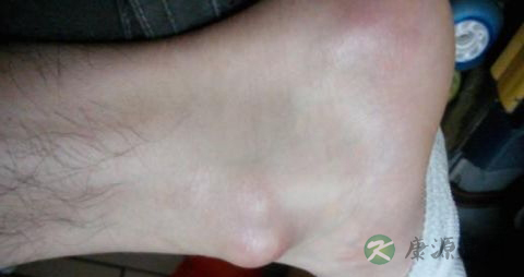 老人脚后跟长骨刺怎么办