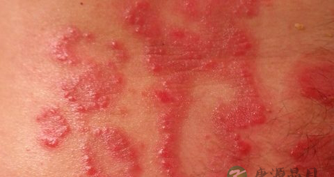银屑病的原因