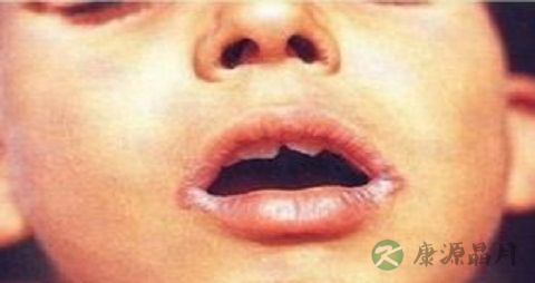 口角生疮是什么原因