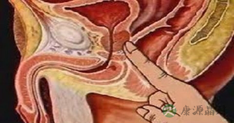 直肠息肉的症状