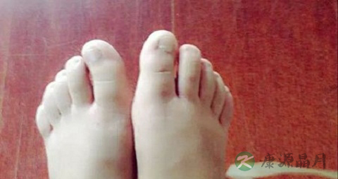 淋巴水肿的症状